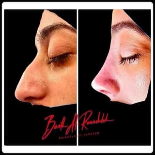 Imagem de perfil de قناة تجميل الأنف للبروفيسور باعث رواشدة no Telegram